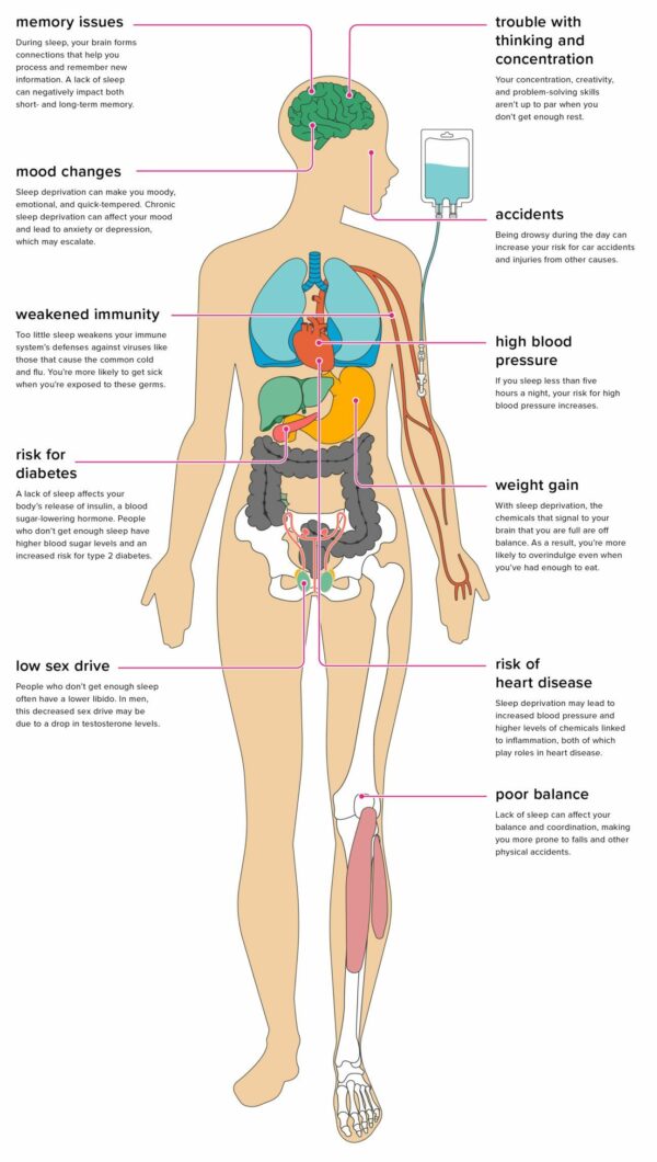 Diagram of Sleep Deprivation Effects on Health